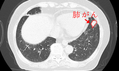 CT検査